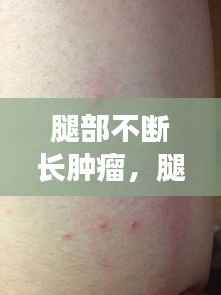 腿部不断长肿瘤，腿上长肿瘤一定是恶性的吗? 